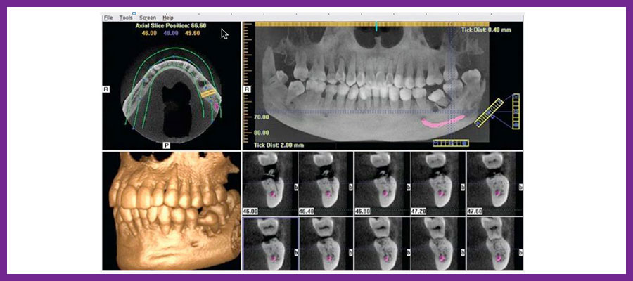 جراحی دندان عقل با سی تی اسکن دندان