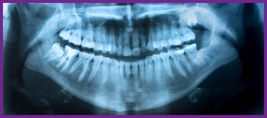 آیاخطر رادیوگرافی دندان جدی است؟