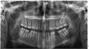 رادیوگرافی پانورامیک | تصویربرداری پانورامیک