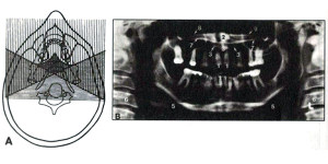 مفاهیم آناتومی طبیعی در رادیوگرافی پانورامیک (قسمت دوم)