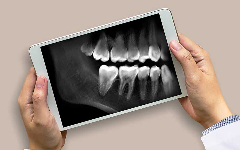 همه چیز درباره نحوه تشخیص پوسیدگی دندان کلینیک دندانپزشکی تخصصی ایده آل