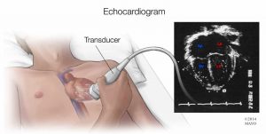 اکوکاردیوگرافی قلب چیست