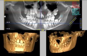 کاربرد CBCT و اندو دندان