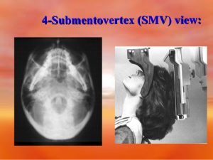 Submentovertex