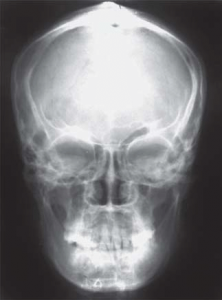 posteranterior cephalometric