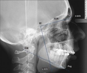 رادیوگرافی lateral-cephalometric چیست