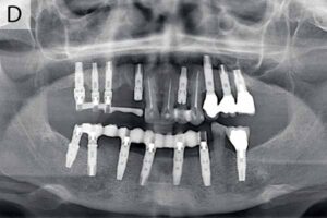 رادیوگرافی پانورامیک ایمپلنت دندان