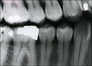 Cervical burnout