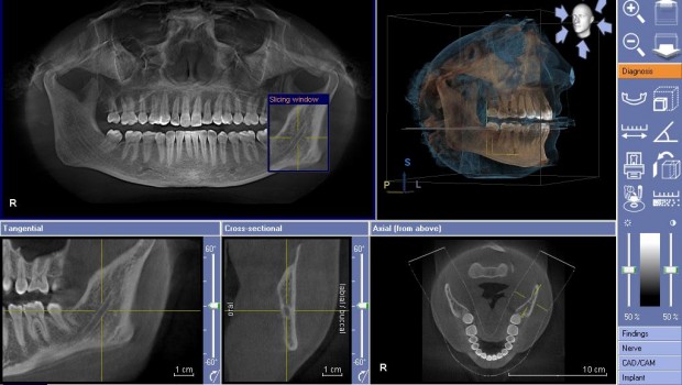 آشنایی با CBCT، سی تی اسکن دندان