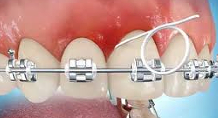 مراقبت از دندان های ارتودنسی شده