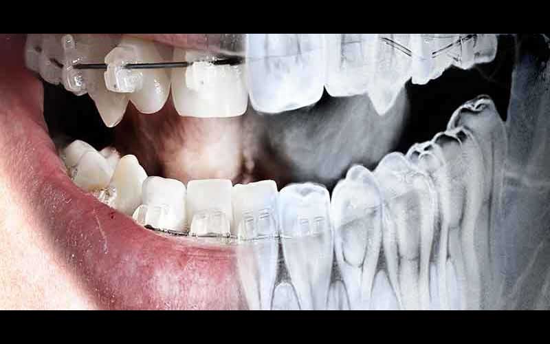 سوالاتی درباره رادیولوژی دندان ها