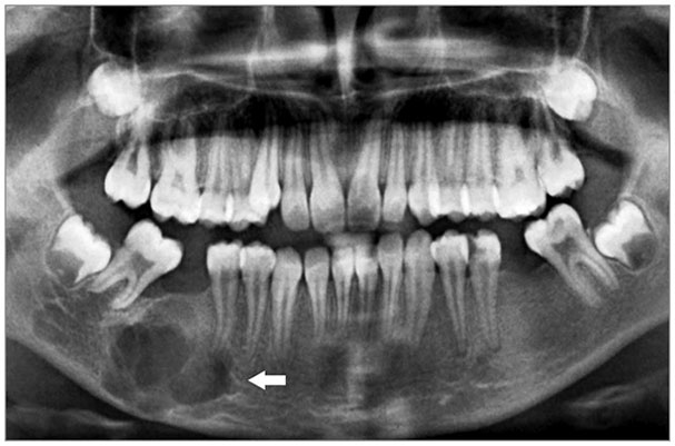 تظاهرات کلینیکی تومورهای خوش خیم